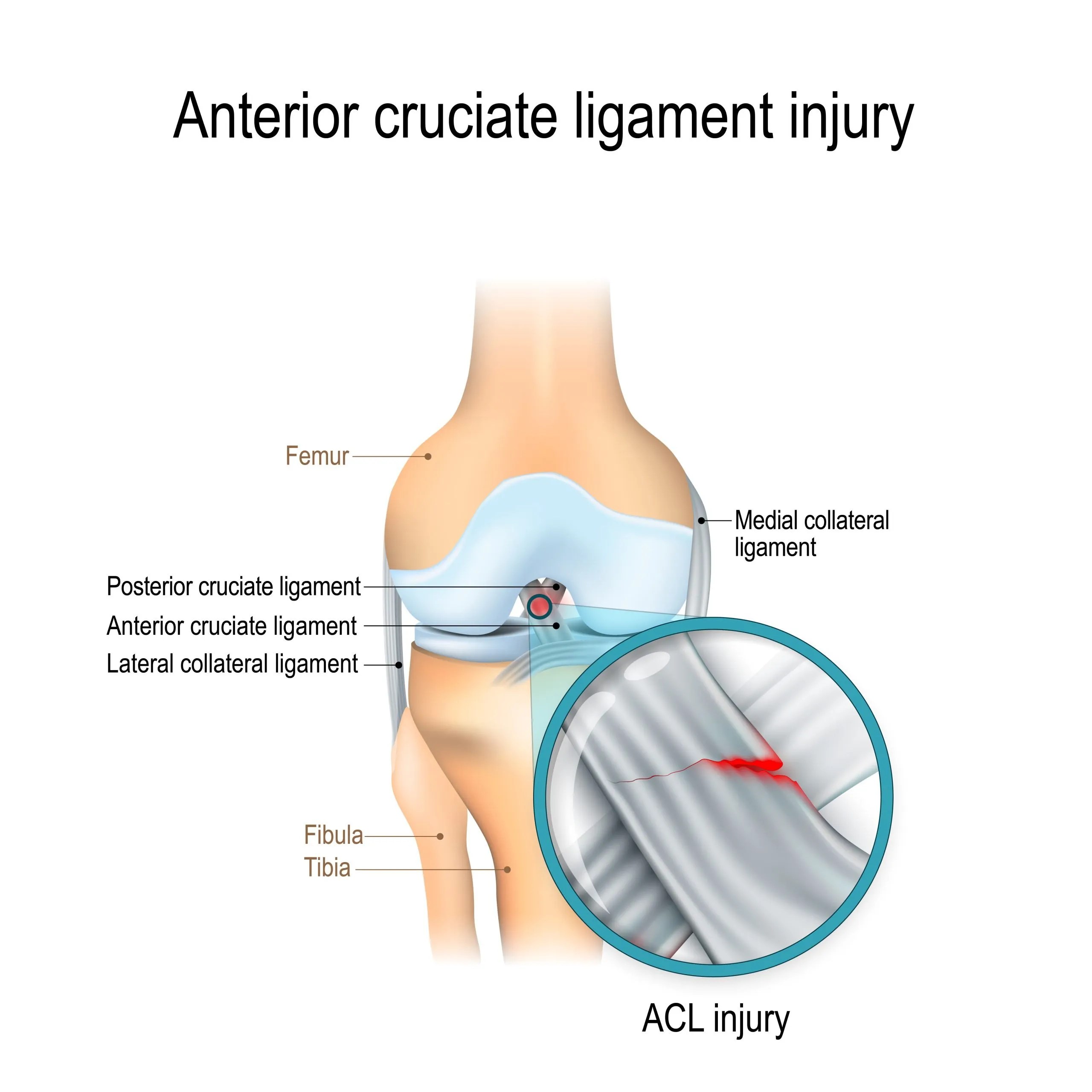 Anterior Cruciate Ligament Injuries Physioflow PT Physical Therapy