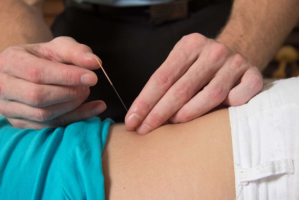 Dry Needling Jerusalem Physiotherapy and Pilates