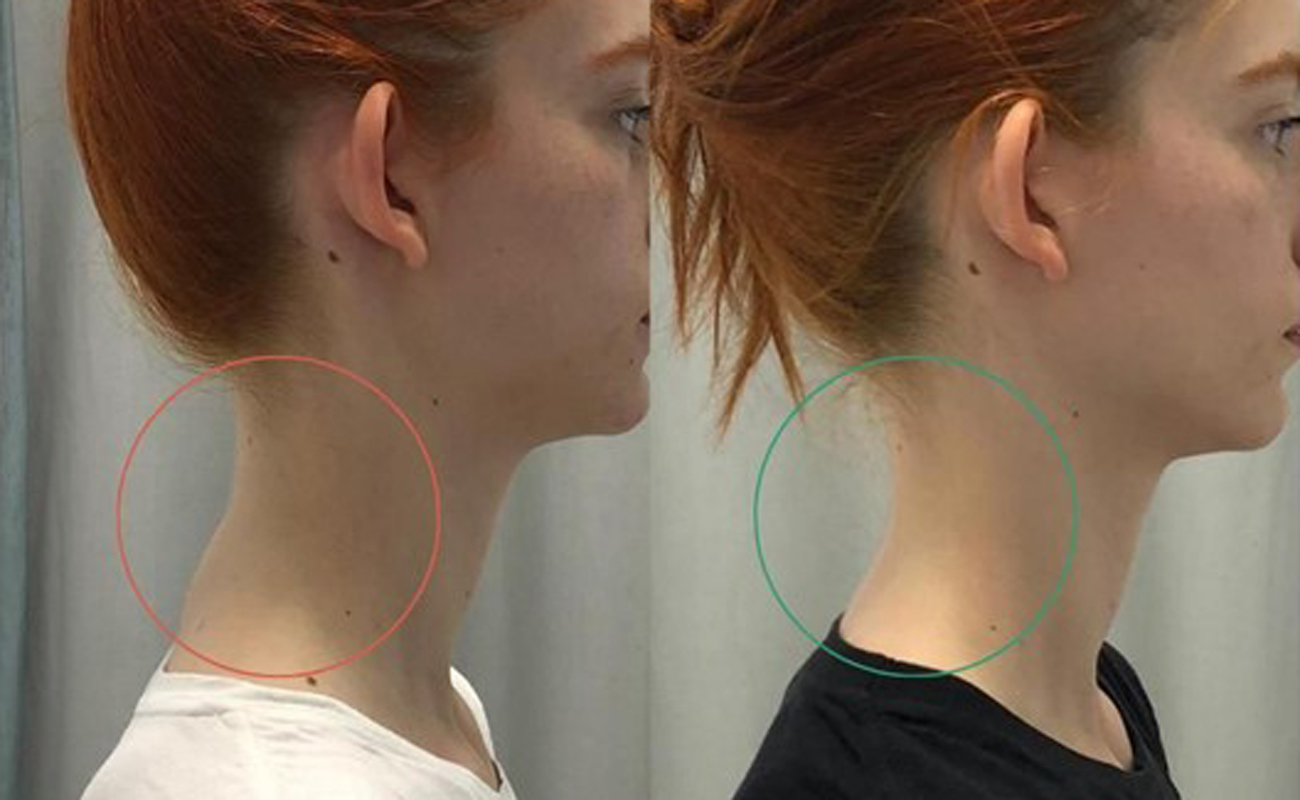 Return of the loss of the arch of cervical lordosis Physiolife Therapy