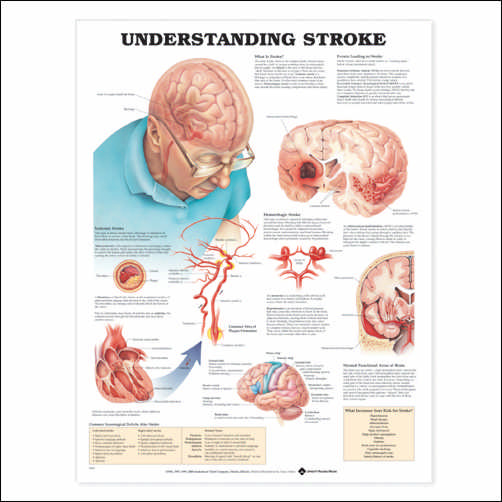 Understanding Stroke Anatomical Chart Physio Needs