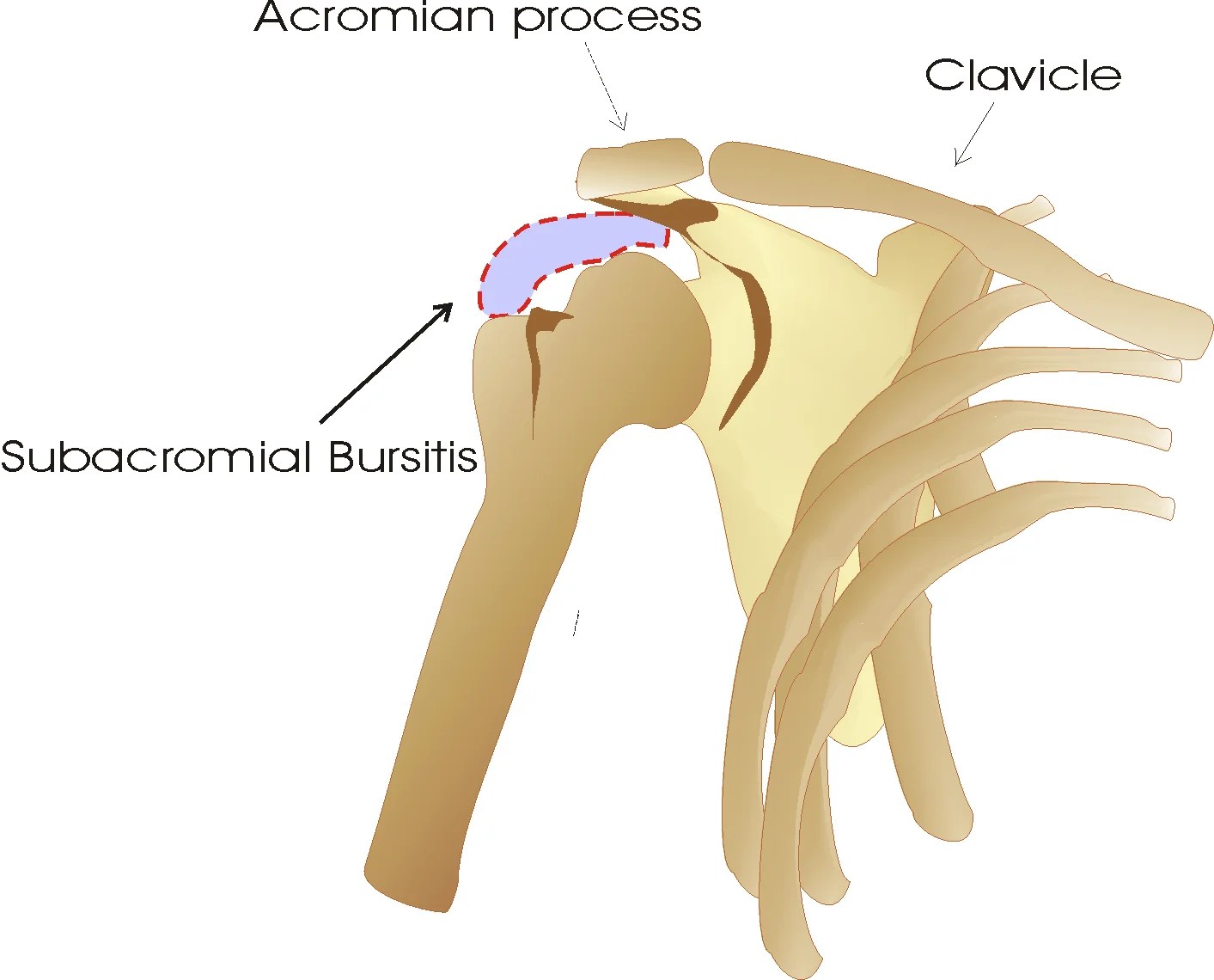 Subacromial bursitis Causes, Treatment & Exercises Physiosunit