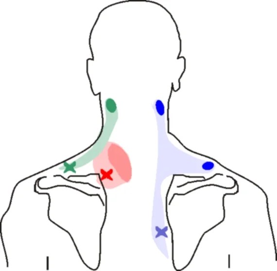 Neck pain left side Physiosunit