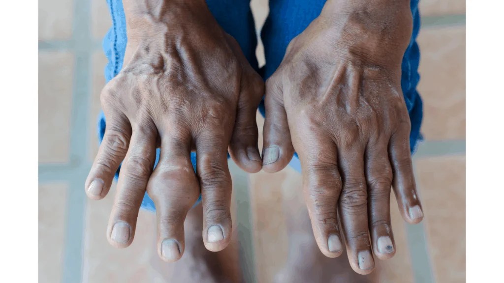 9 Pictures of the Gout Symptoms, Food to avoid, other tips Physiosunit