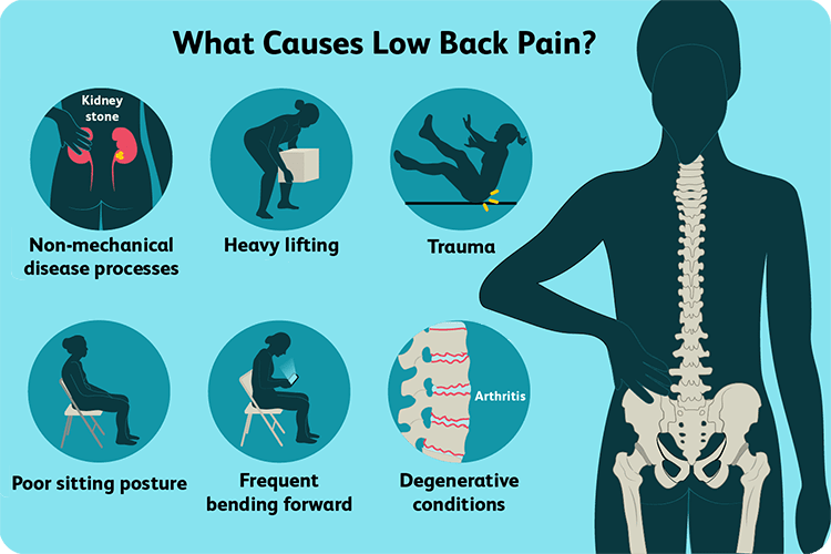 Back Pain Specialist Physiovive Barrhaven Physiotherapy Services
