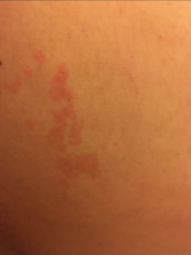 what is this rash on my inner thigh Glow Community