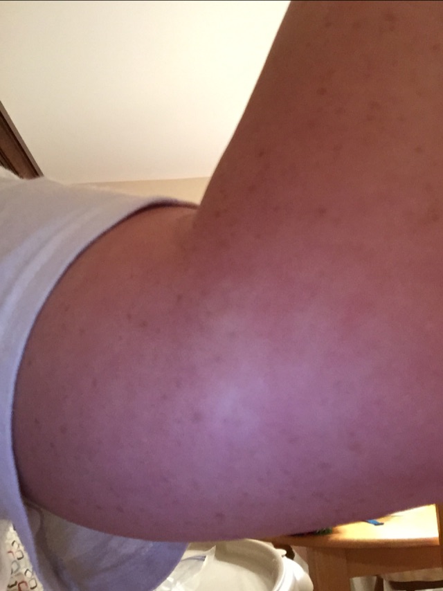 White bumps from tanning bed... Anyone know what these are? Glow