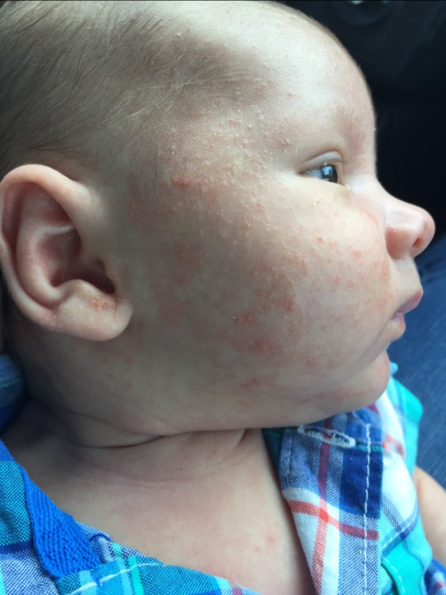 Baby Acne On Neck And Ears