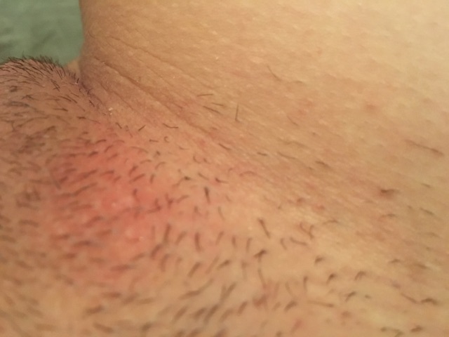 Are these razor bumps/burns from shaving? Glow Community
