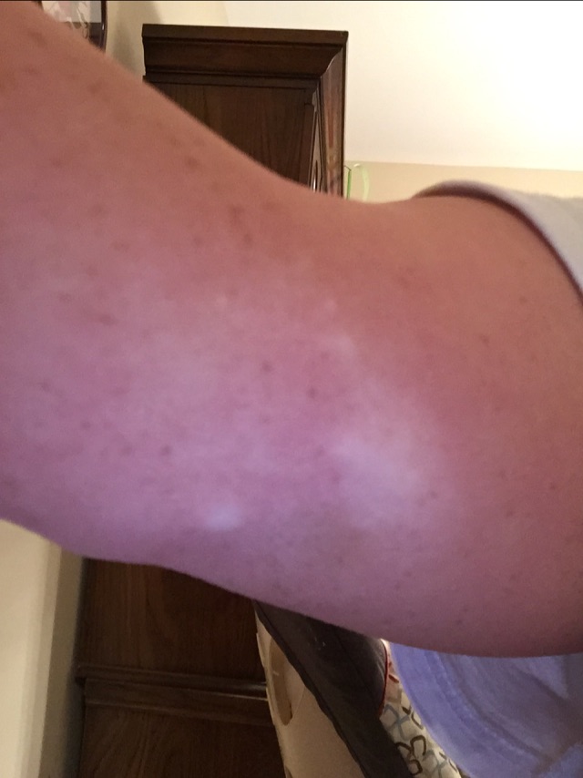 White bumps from tanning bed... Anyone know what these are? Glow