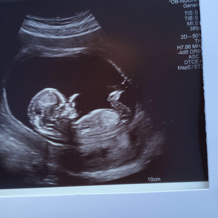 Gender At 12 Weeks 5 Days ovulation signs