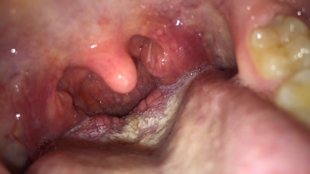 Oral Thrush An Early Pregnancy Symptom??? - Glow Community