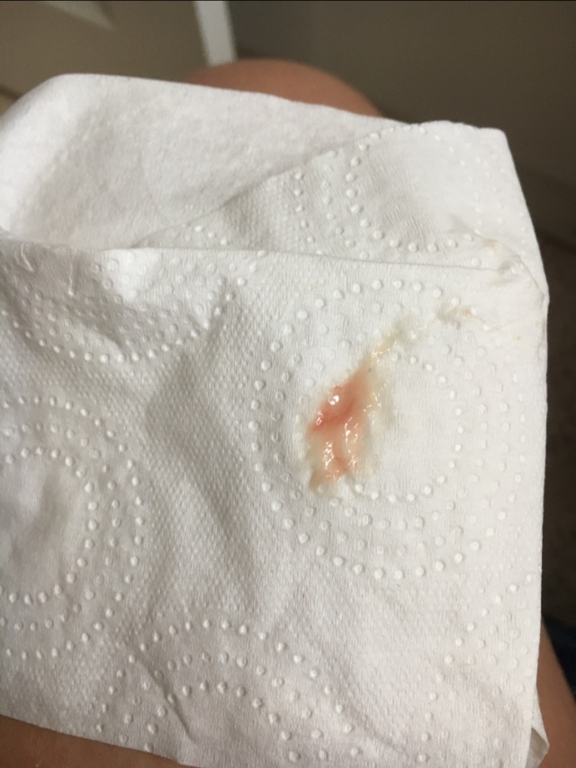 TMI (picture) implantation bleeding 8dpo Glow Community