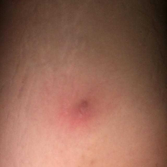 Bump on inner thigh for a month Glow Community