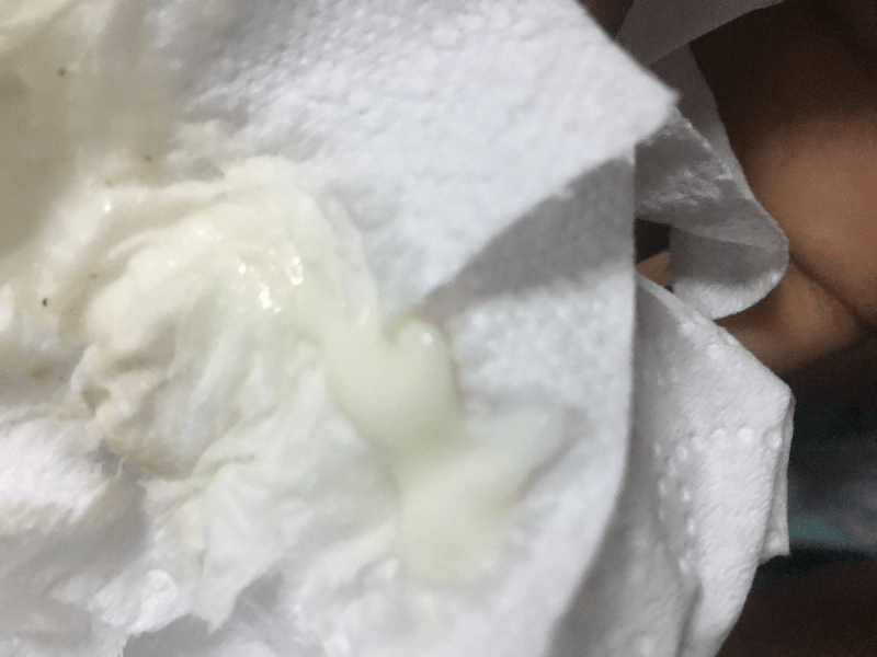 Early Pregnancy White Discharge