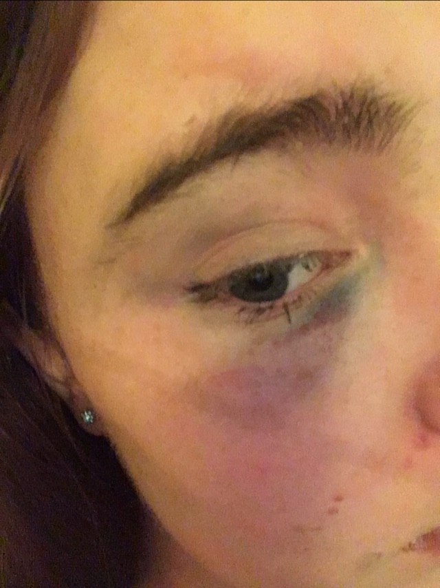 Bruise under eye, Help? Glow Community