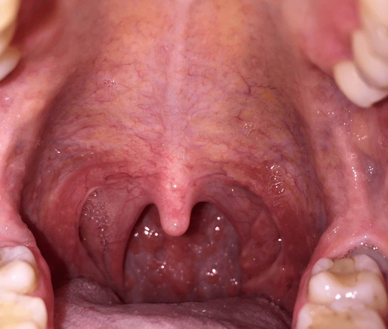 please help. scared. bumps back of throat/mouth Glow Community