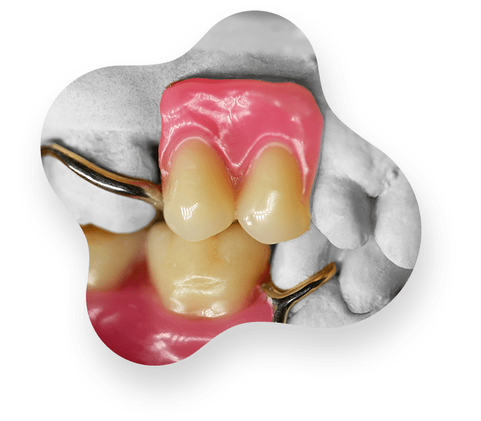 Removables Picasso Dental Studios