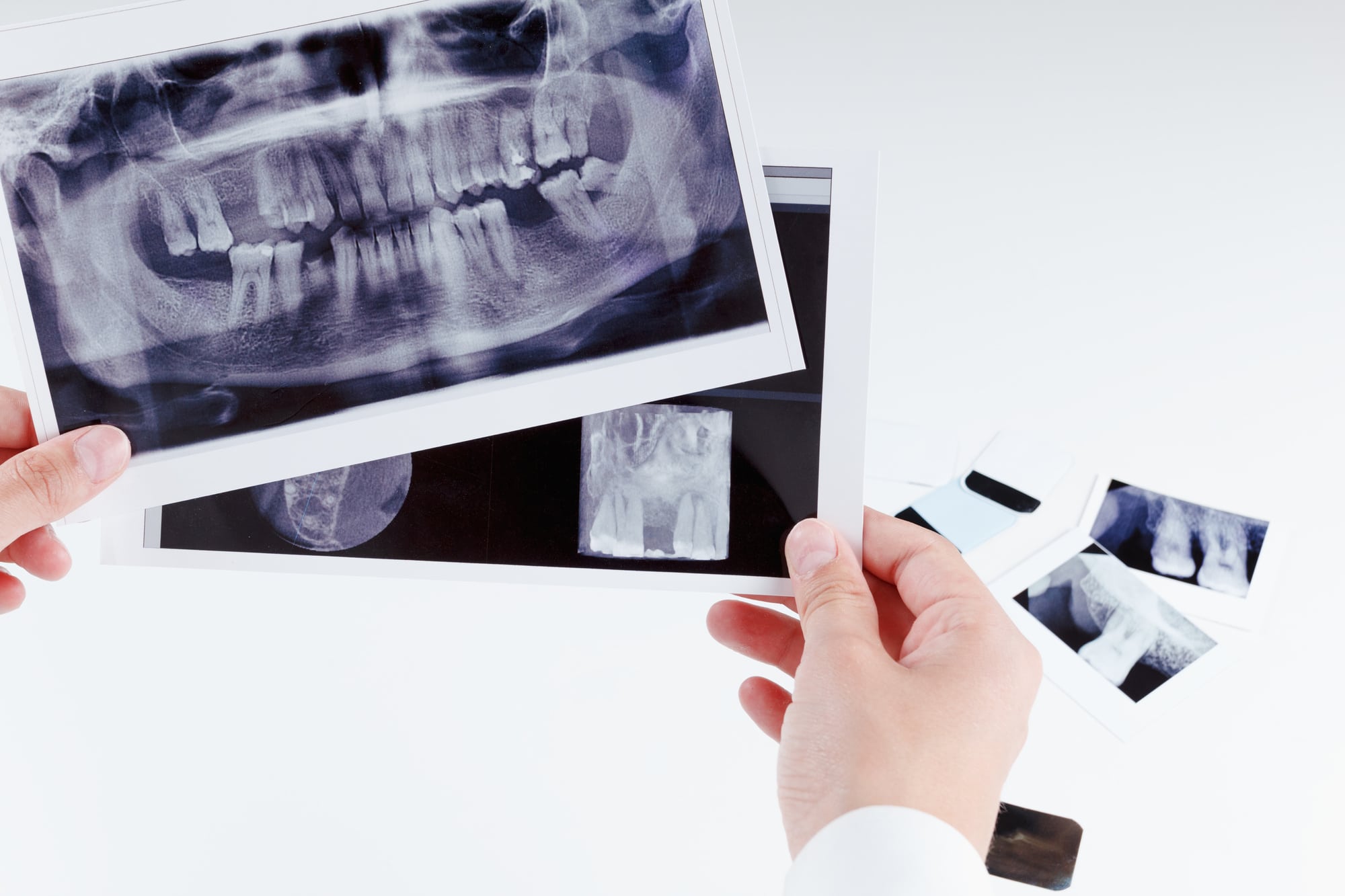 5 Surprising Benefits of Dental XRays