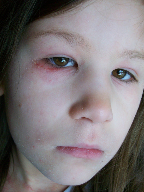How I Got My Daughter's Eczema Under Control
