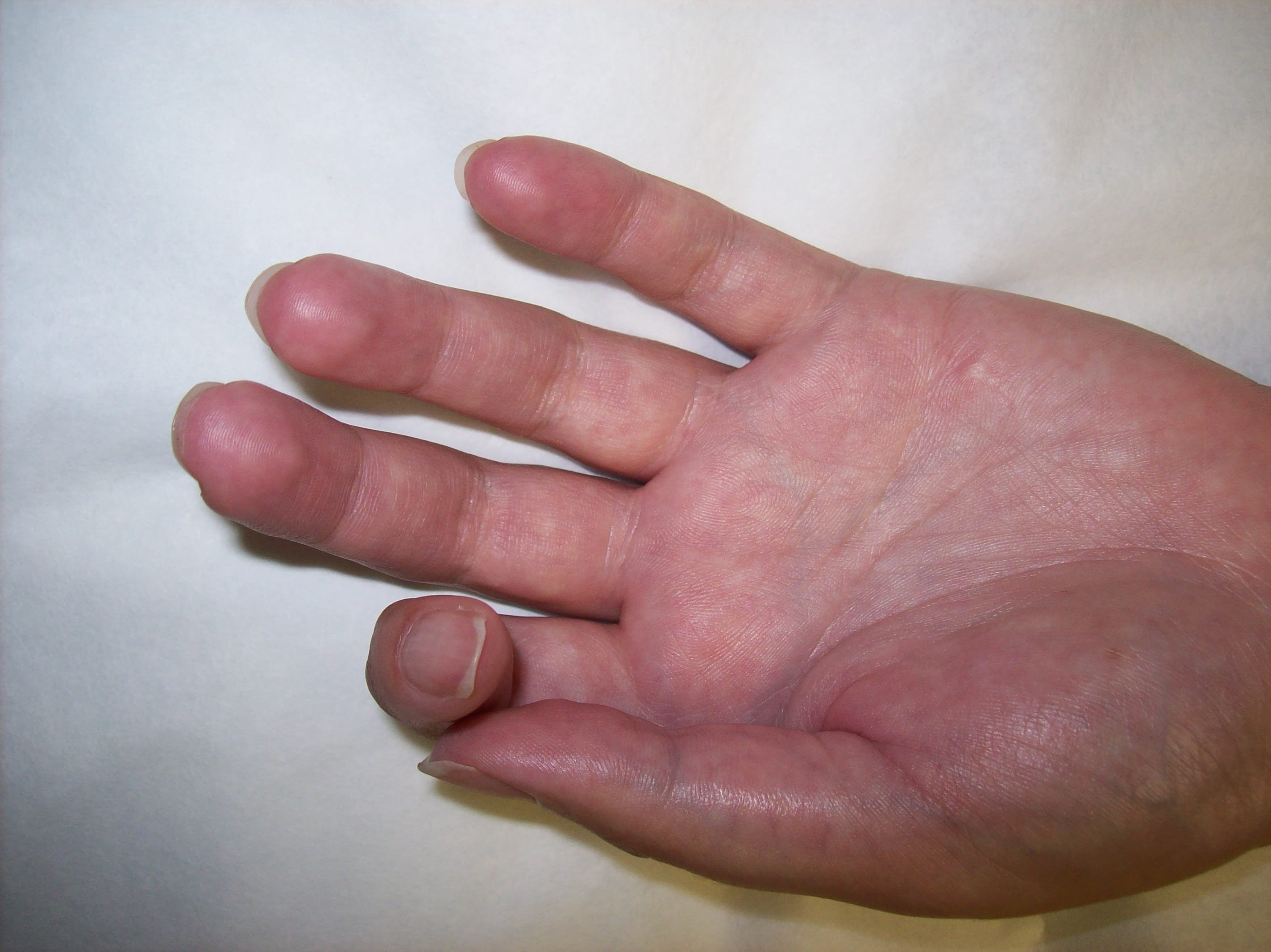 Understanding Reflex Sympathetic Dystrophy (RSD/CRPS) and its Treatment