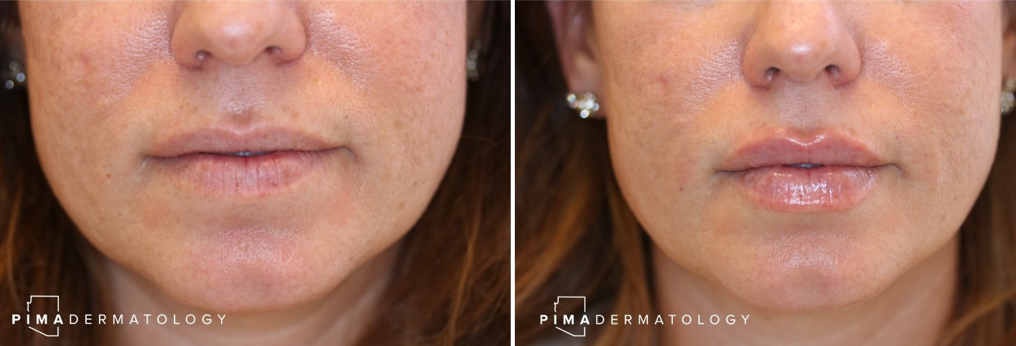 Dermal Filler Injections by Tucson Dermatology Specialists