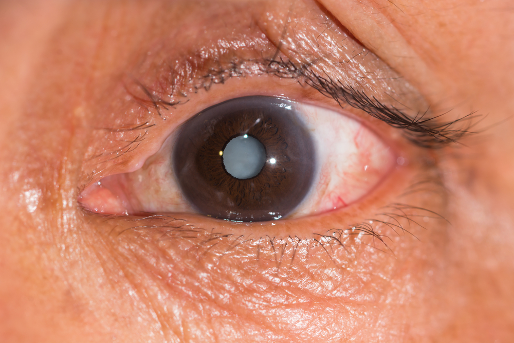 Cataracts Symptoms Of Cataracts Vision Direct AU