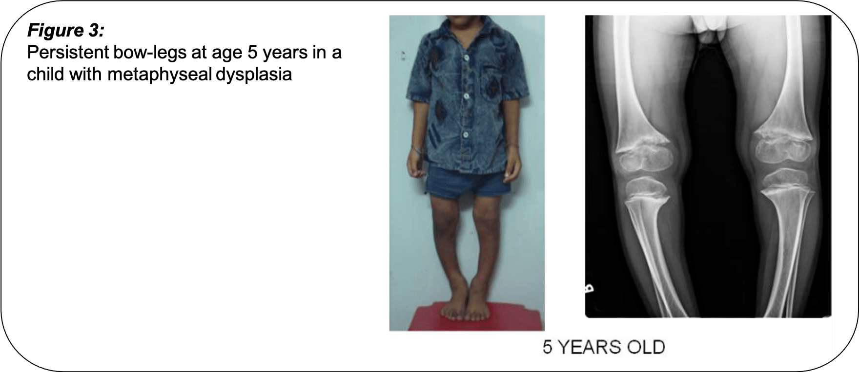 What Causes Bow Legs in Children's Pinnacle Orthocentre Hospital