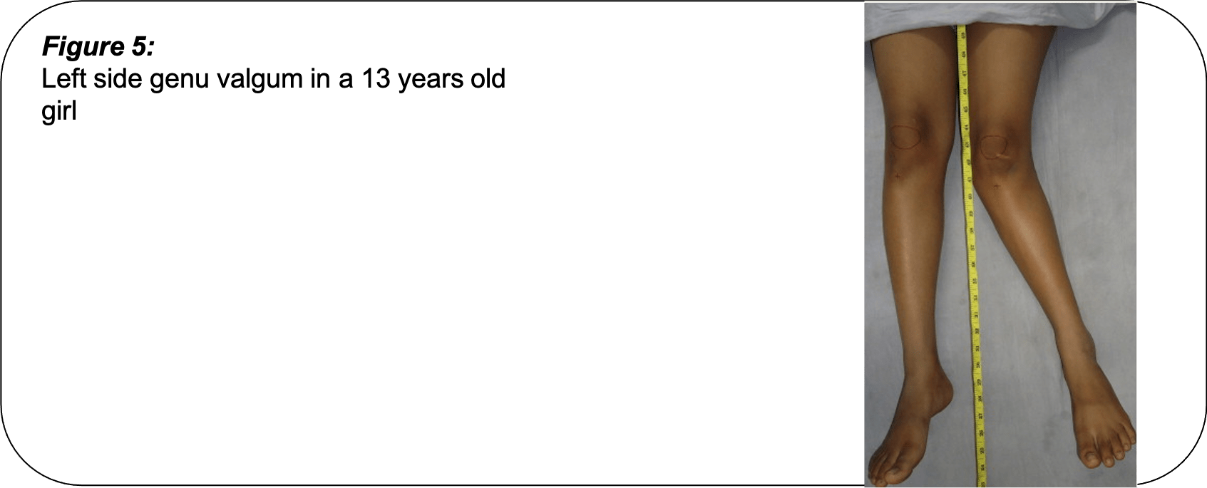 What Causes Bow Legs in Children's Pinnacle Orthocentre Hospital