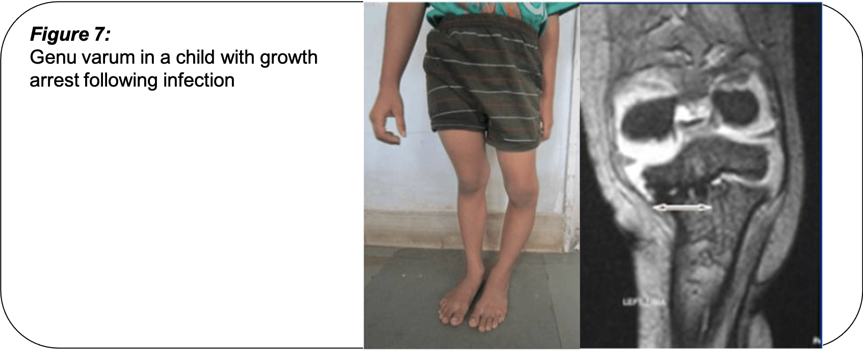 What Causes Bow Legs in Children's Pinnacle Orthocentre Hospital