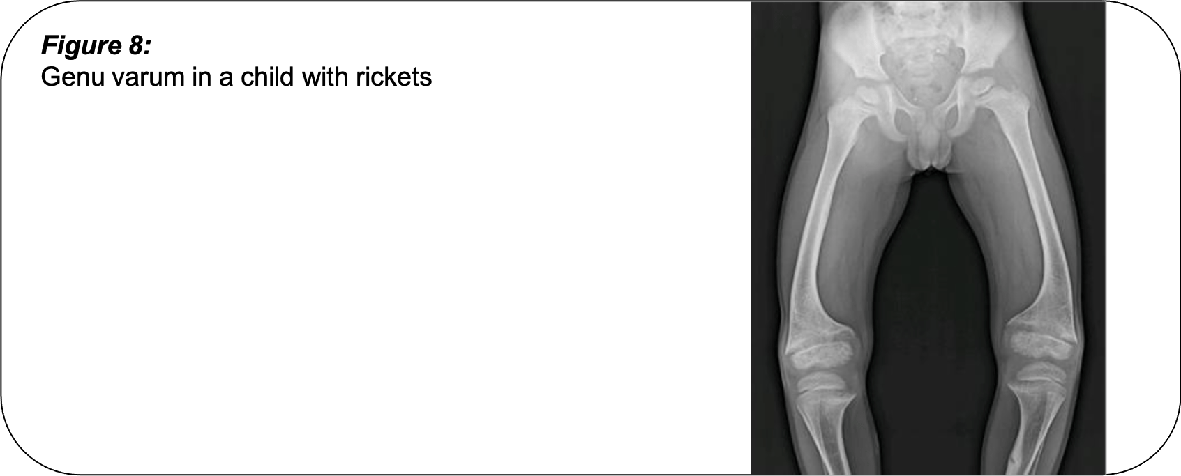 What Causes Bow Legs in Children's Pinnacle Orthocentre Hospital