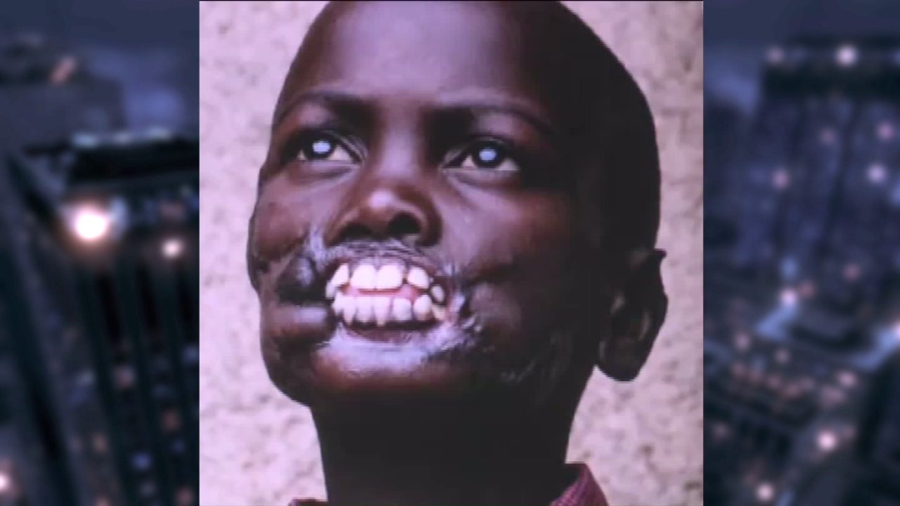 Boy whose face was ripped off by chimps undergoes facial surgery in New