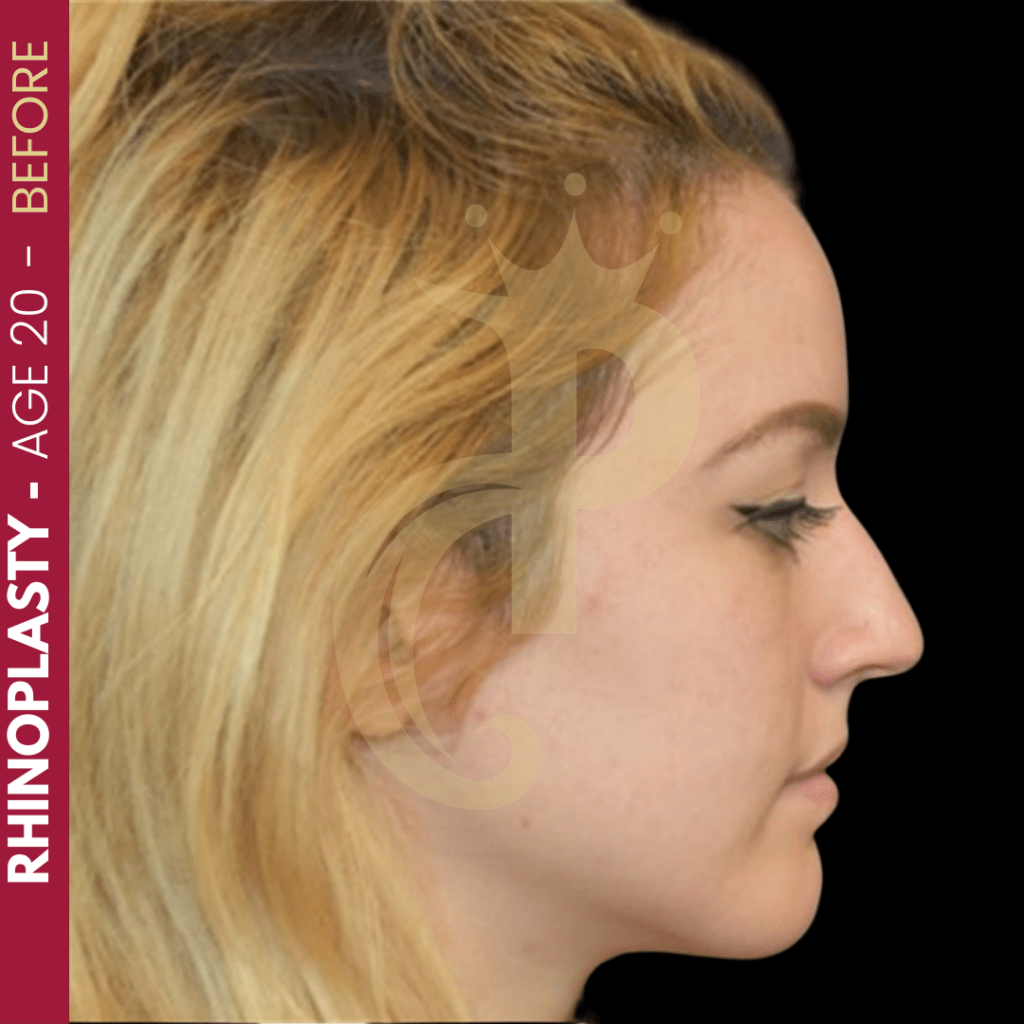 Rhinoplasty in Turkey Cost, Result, Procedure, Best Pixl Clinic