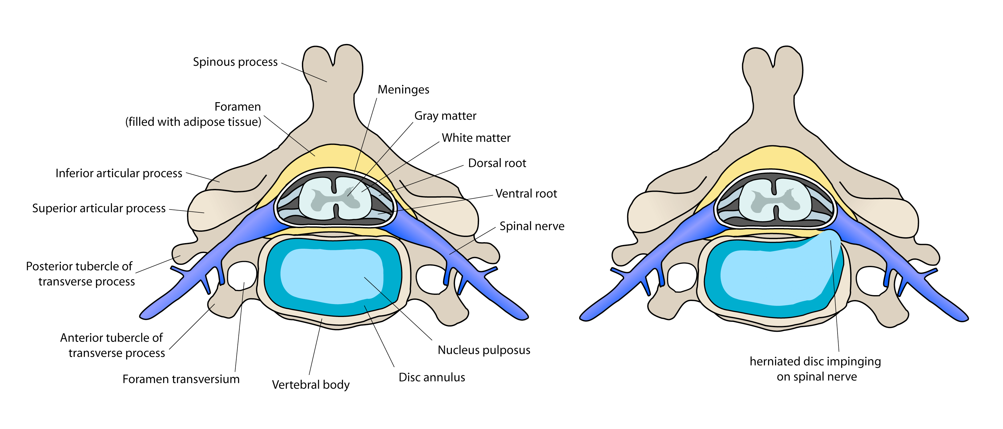 Posterior central disc protrusion free image download