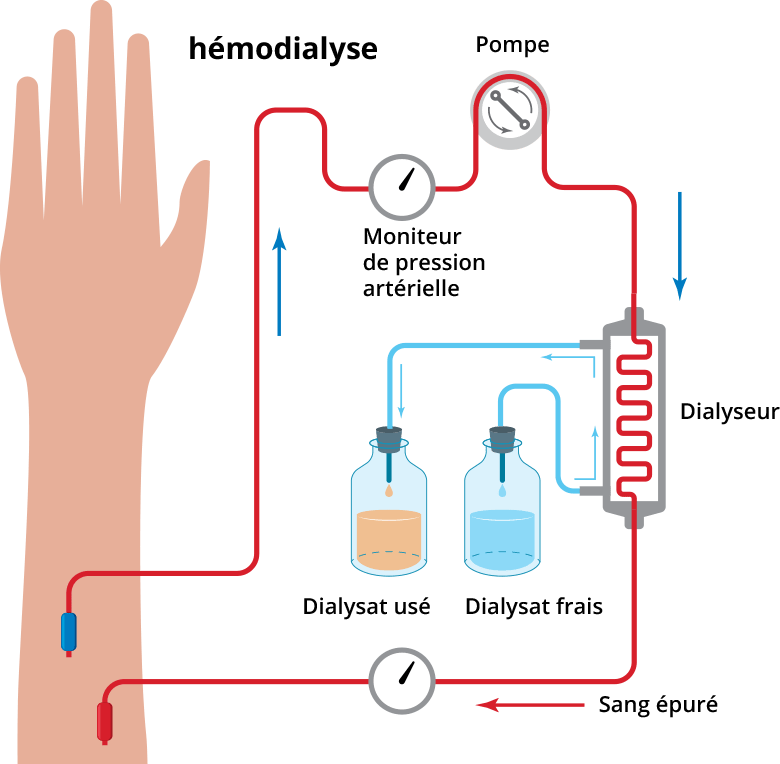 Les solutions de suppléance de l’insuffisance rénale La PKRAD