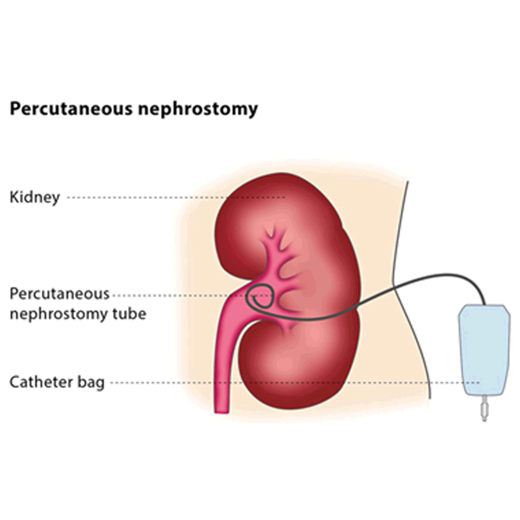 NEPHROSTOMY PKLI&RC