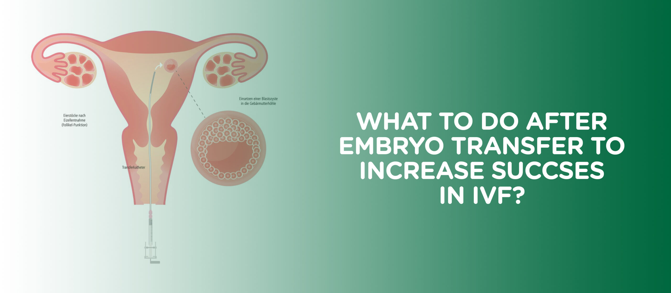 What to Do After Embryo Transfer to Increase Success in IVF?