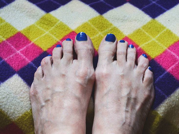 Metatarsalgia (Pain in the Ball of Your Foot) Causes & Treatment