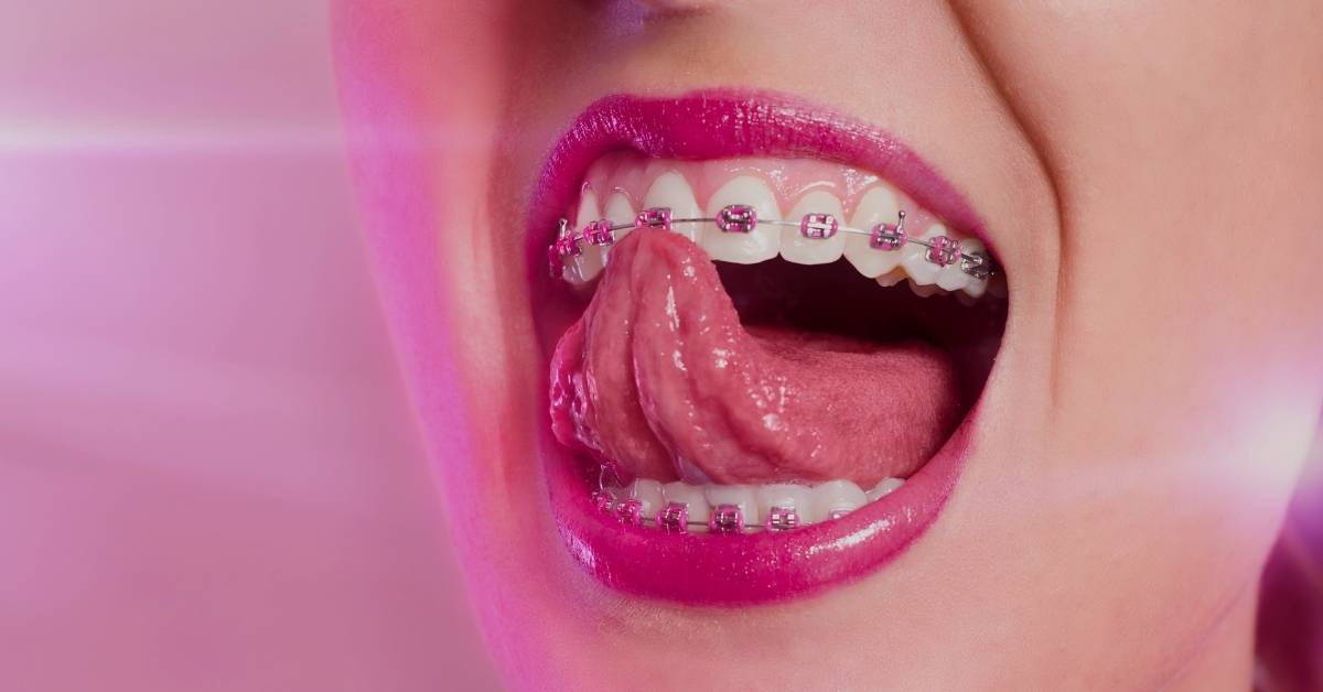 20 Cute Braces Colors & Color Combinations Stylish In 2024