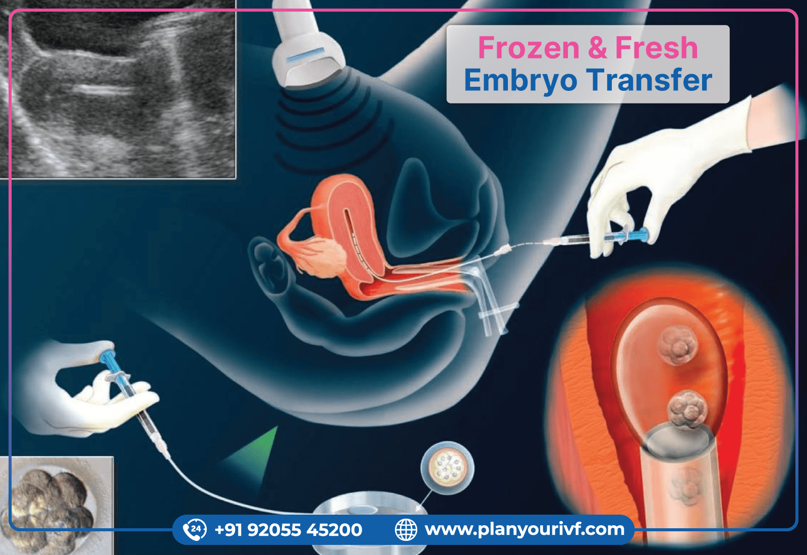 Fresh Embryo vs Frozen Embryo Transfer in IVF Planyourivf