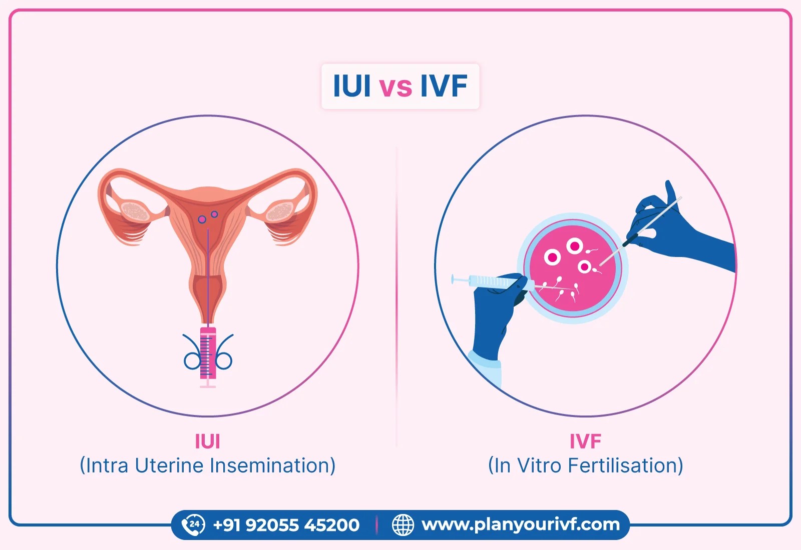 What is difference between IVF and IUI? Plan Your IVFPlan Your IVF