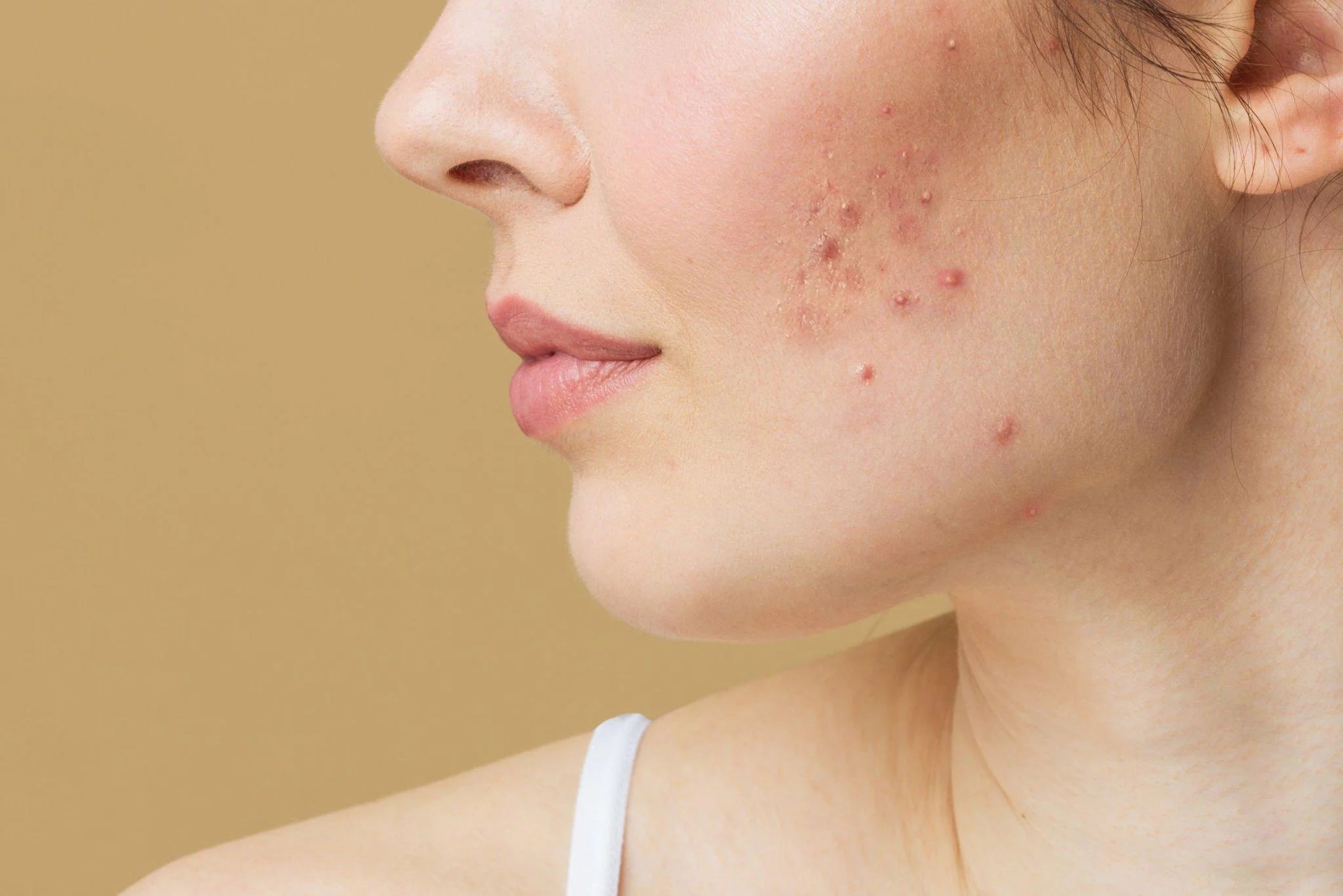 Can Exosome Treatment Cure Acne? Plasma Therapy