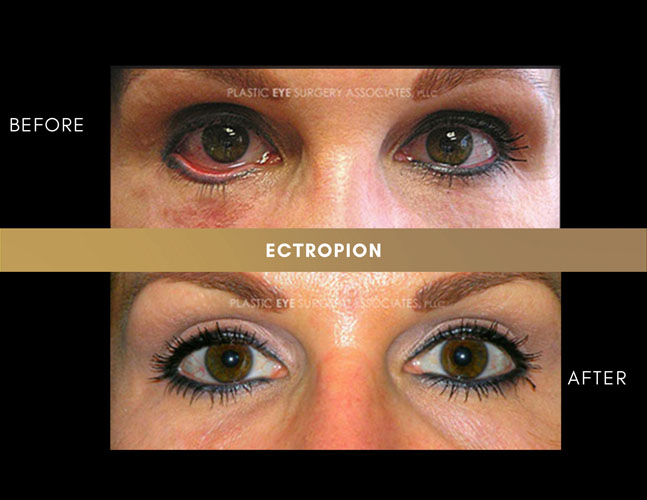 Ectropion Entropion Photos Plastic Eye Surgery Associates