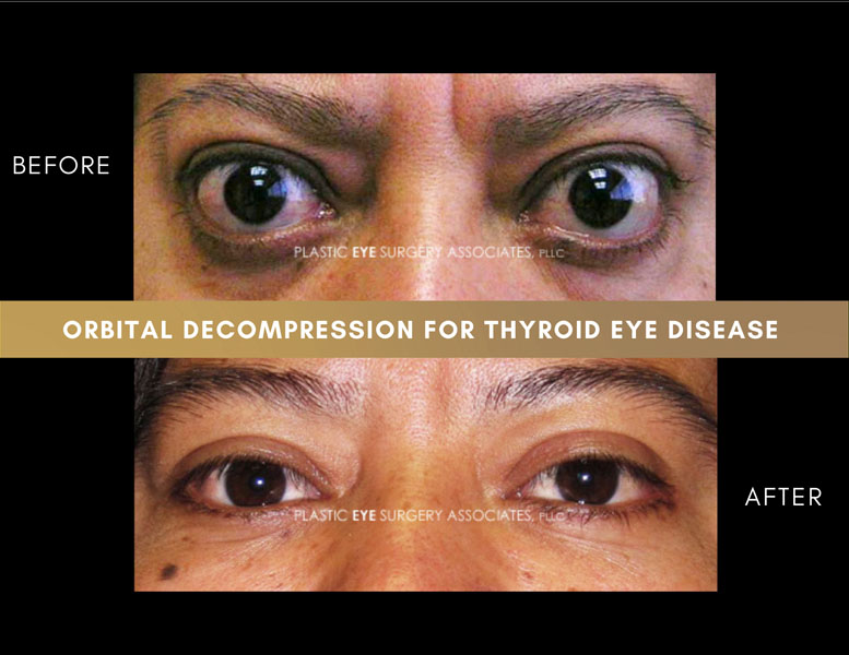 Thyroid Eye Disease Photos Plastic Eye Surgery Associates