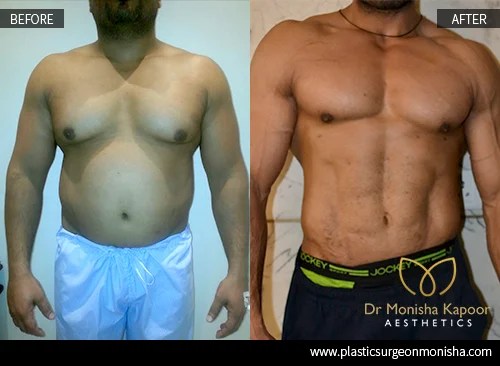 Six Pack Surgery For Men Abdominal Liposuction Men