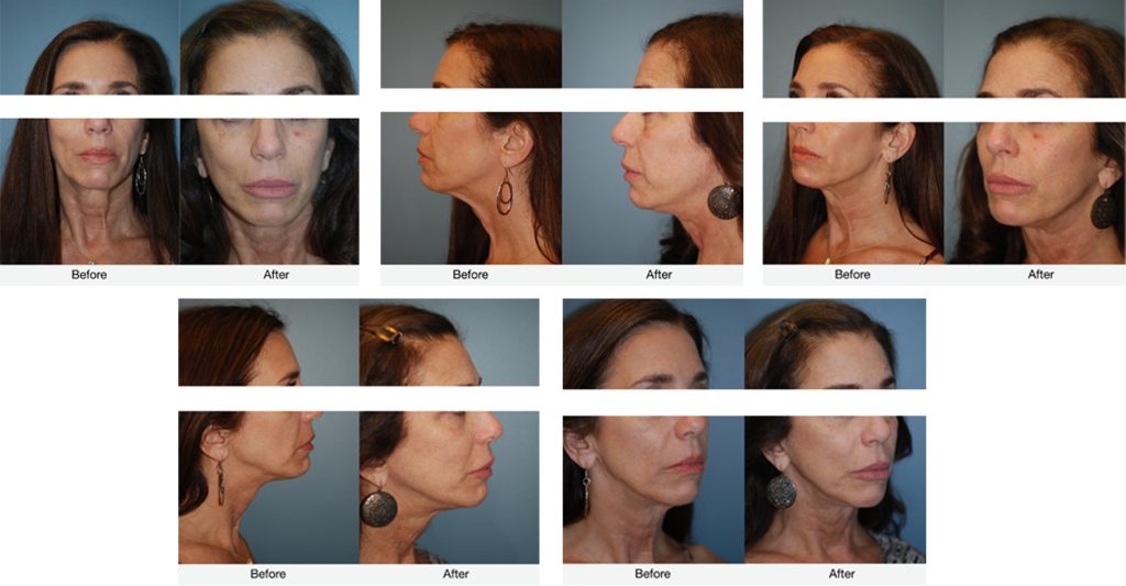Facelift Nyc Facelift Specialist Nyc Facelift
