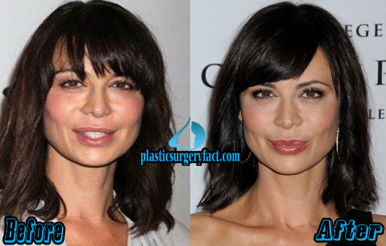 Catherine Bell Plastic Surgery Before and After Photos