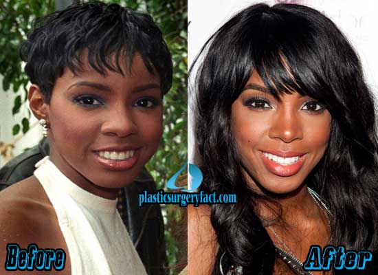 Kelly Rowland Nose Job Before and After Plastic Surgery Facts