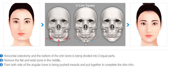 South Korean Plastic Surgery Cost and Procedures Plastic Surgery Facts