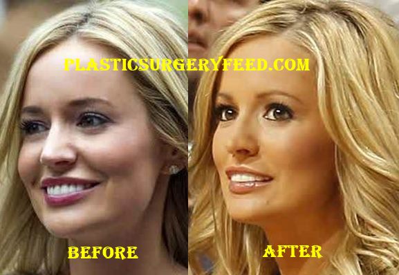 Emily Maynard Plastic Surgery - Plastic Surgery Feed