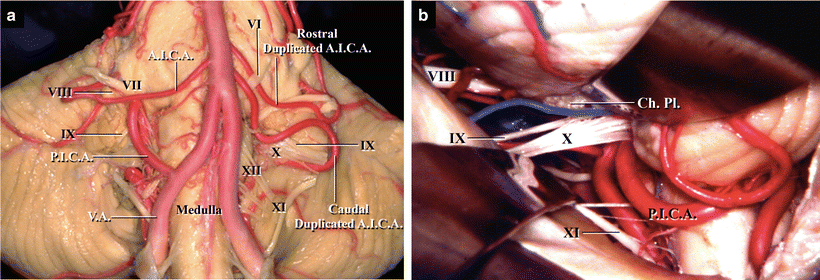 Microvascular for Glossopharyngeal Neuralgia Surgical